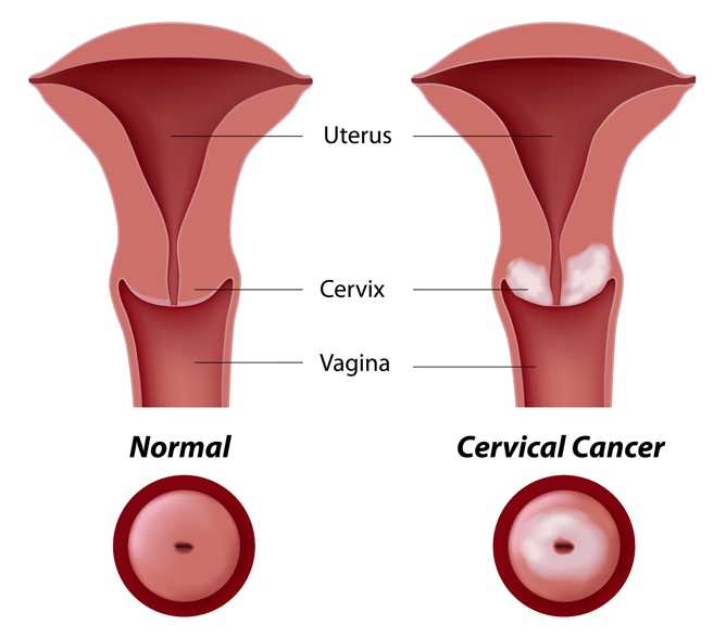 Cervical cancer in Kenya