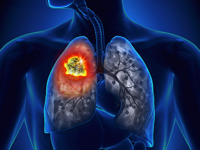 Lung Cancer in Kenya