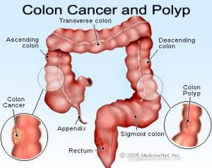 Colon Cancer in Kenya