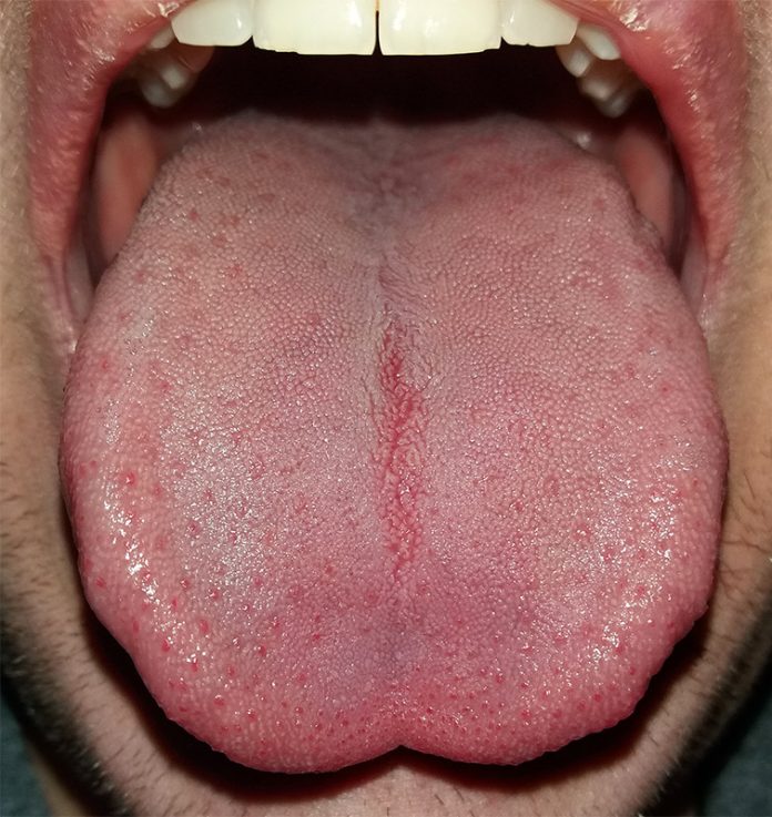 6 Things Your Tongue Can Reveal About Your Health NewsDay Kenya