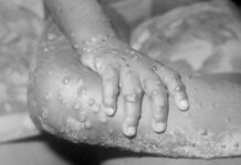What is Mpox and What is Its Prevention Measures? Get the Insights as Kenya Confirms First Case